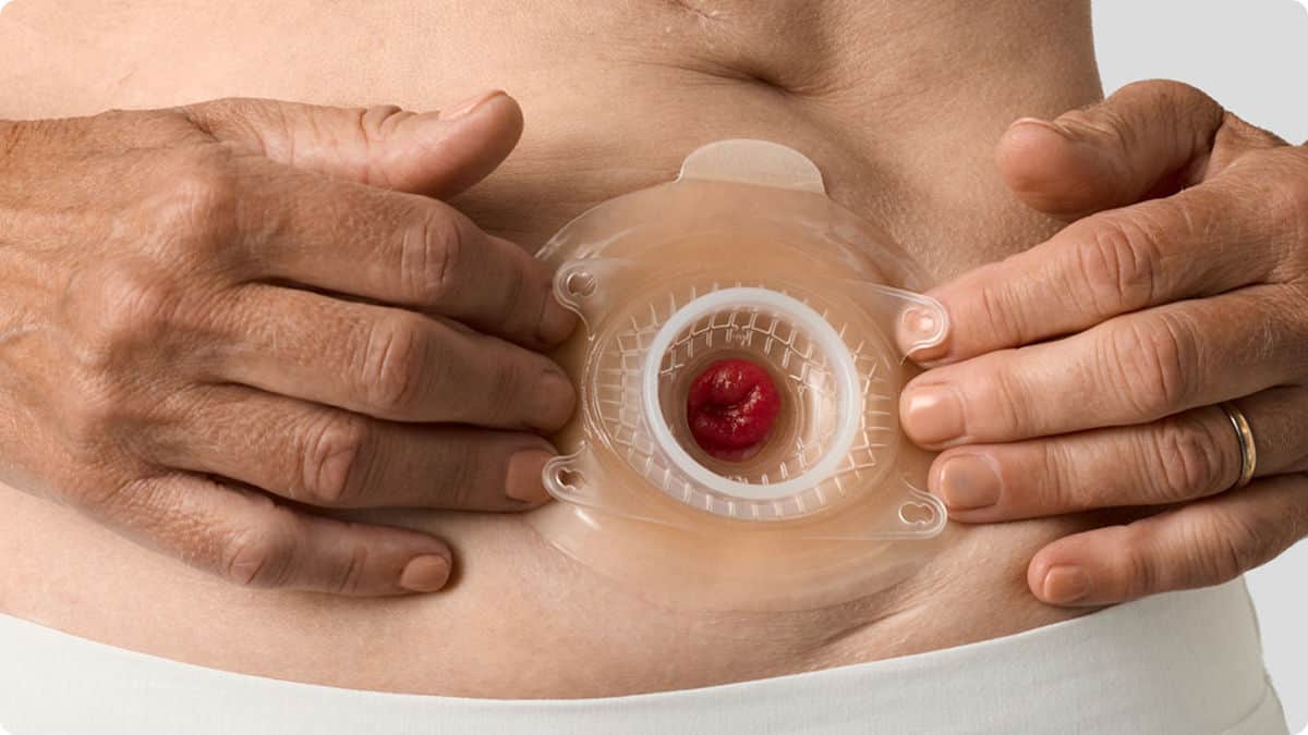 La convessità può fare la differenza per molte persone con un'urostomia
