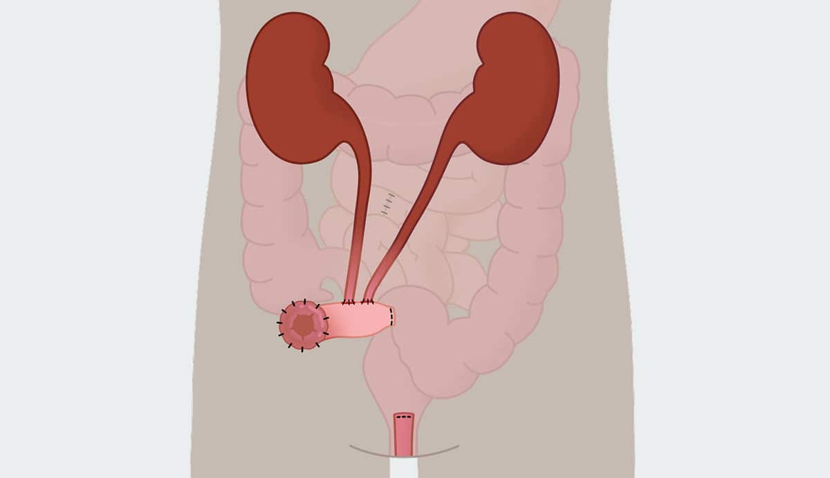 Che cos’è un’urostomia?