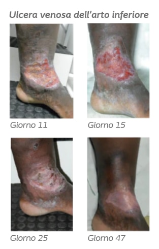 Venous leg ulcer healing process 530x530.png