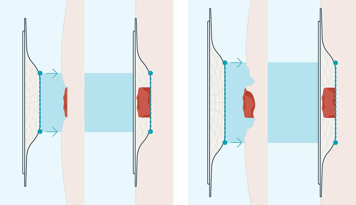 Il posizionamento della tensione è fondamentale<sup>3</sup>